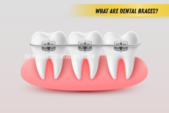 Expert orthodontic treatment in Coimbatore with braces and aligners for perfect smile correction